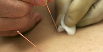 ALTERNATIV: Homeopater og akupunktører mener de har hjelp mot blærekatarr. ALTERNATIV: Homeopater og akupunktører mener de har hjelp mot blærekatarr.
