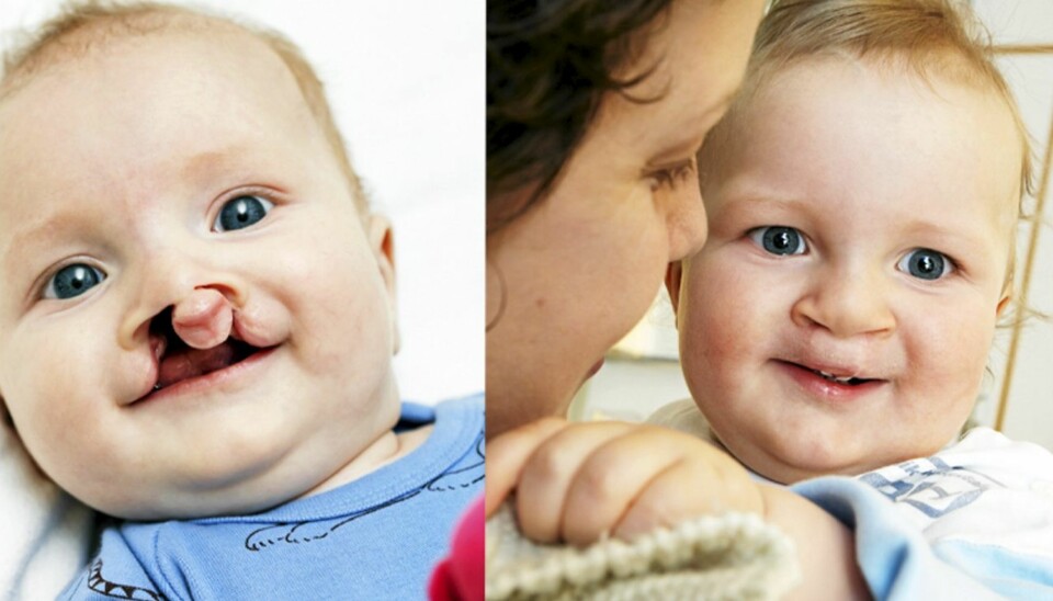 FØR OG ETTER: Lille Marius er blitt operert tre ganger, og om noen få år blir det enda flere. - Vi har en ekstra utfordring i å gjøre ham sterk, sier mamma Hanne.