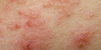 IRRITERT: Rødflammet og fet hud kan bety noe mer. IRRITERT: Rødflammet og fet hud kan bety noe mer.