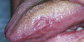 TUNGEPLAGE: Bildet viser et eksempel på misfarging og munnskold/afte på tungeranden.