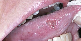 KREFT: Bildet viser et kreftsår på tungen.