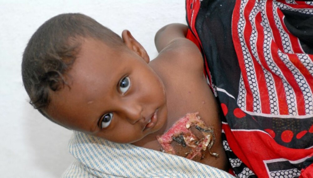 MAKABER TRADISJON: Stammefolk i Etiopia støtter seg på gammel overtro når syke barn behandles med dødelig brennemerking.
