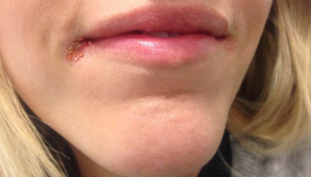 HERPES MUNNSÅR: Ser leppene dine slik ut? Her er symptomene på herpes munnsår, og hvordan du behandler det. FOTO: Jenny Mina Rødahl.
