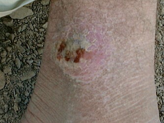 SÅR: Sandfluer overfører en parasitt som kan gi kroniske hudreaksjoner. Bildet er tatt i Afghanistan.