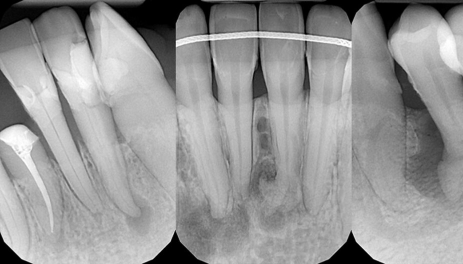 BETENNELSE I TANN: Her er tre røntgenbilder som viser hvordan det kan gå når man får en betennelse i tannen/tannroten. Dette skjer om man ikke tetter hull og det kommer bakterier inn i tannen fra utsiden. 

De mørke flekkene/sirklene er betennelse som har ført til at kjevebeinet blir betent og etterhvert borte. – Alle disse tre tennene gjør nok relativt vondt, sier Dan Stensen, eier og daglig leder av Krakows største private tannklinikk, Dentestetica.