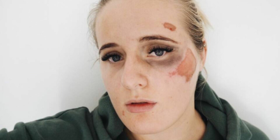 TRUSLER: Da Martine Halvorsen postet dette bildet etter å ha blitt slått ned på gata, fikk hun grove trusler om voldtekt. FOTO: Privat TRUSLER: Da Martine Halvorsen postet dette bildet etter å ha blitt slått ned på gata, fikk hun grove trusler om voldtekt. FOTO: Privat