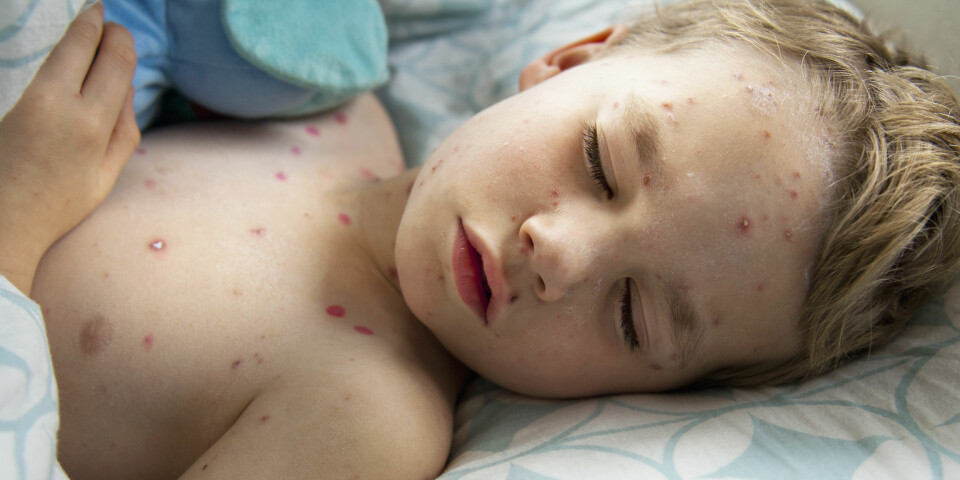 VANNKOPPER: Slik kan viruset se ut på barn. Forløpet merkes først som røde prikker, utvikler seg til større blemmer, og når blemmene sprekker, dannes skorper.