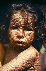 Et barn i Bangladesh smittet med kopper i 1973. Ofte er koppene fylt med væske.