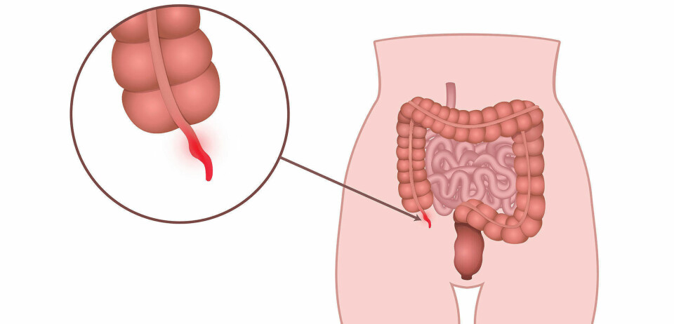 IKKE ET BIOLOGISK BLINDSPOR LIKEVEL? Tusenvis av nordmenn får hvert år blindtarmsvedhenget fjernet på grunn av smertefull betennelse. Nå mener forskere at vedhenget likevel har en viktig, biologisk funksjon.
