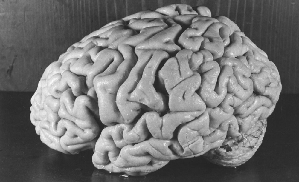 EINSTEINS HJERNE: Dette er Albert Einsteins faktiske hjerne, fotografert av patolog Thomas Harvey etter obduksjonen. Meningen var at den skulle begraves sammen med geniet, men endte isteden opp i en tupperwarebolle på roadtrip gjennom USA over 20 år senere.