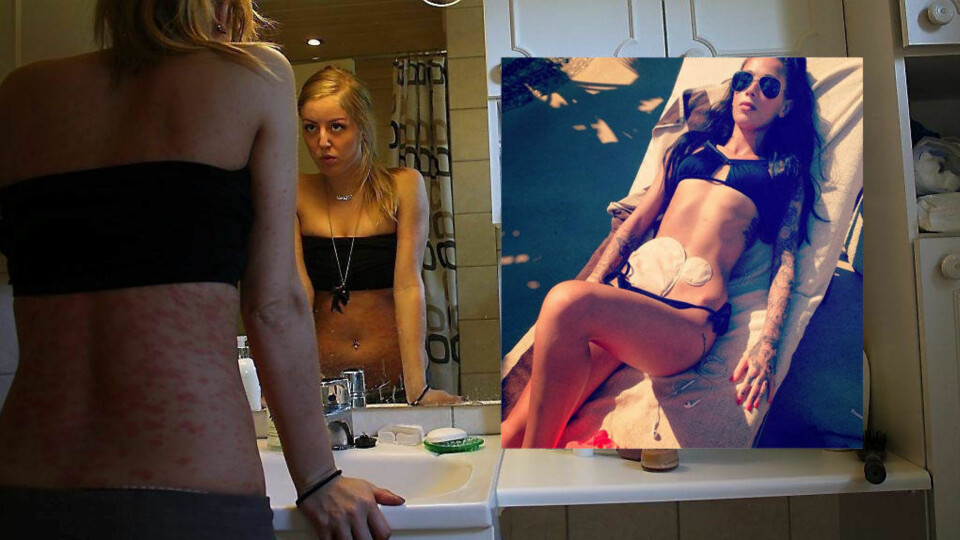 GIR SELVTILLIT: Fra Marie Brudevold fikk psoriasos til hun skrev om det på bloggen tok det et halvt år. Nå synes hun det er viktig å vise frem «avvikene», for å vise andre i lignende sitasjoner at de ikke er alene.