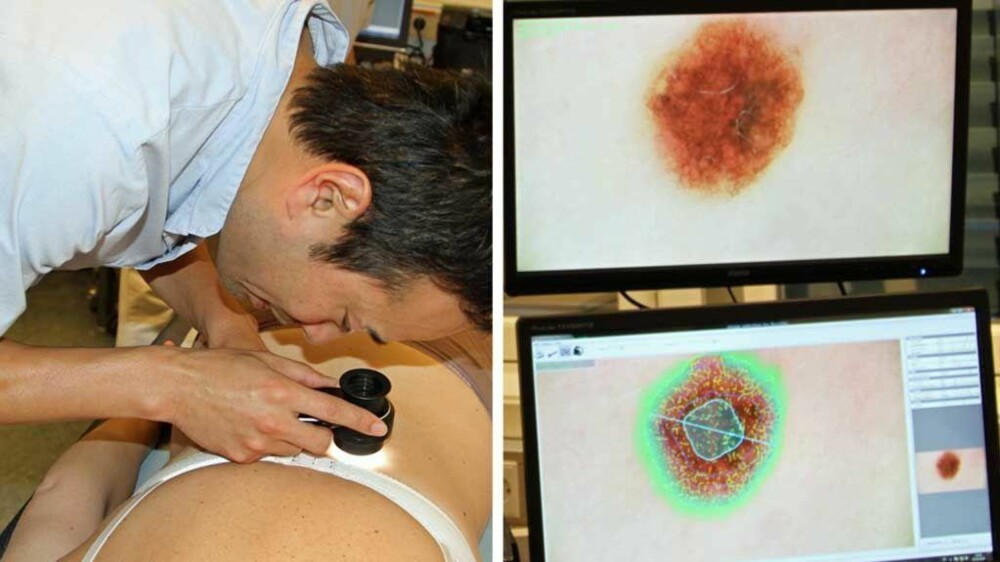 Spesialist i hudsykdommer Xiatong Li ser nøyere på noen føflekker i dermatoskopet. Etterpå blåses noen av føflekkene som er blitt tatt bilde av opp for lettere å se fargenyanser, blant annet.