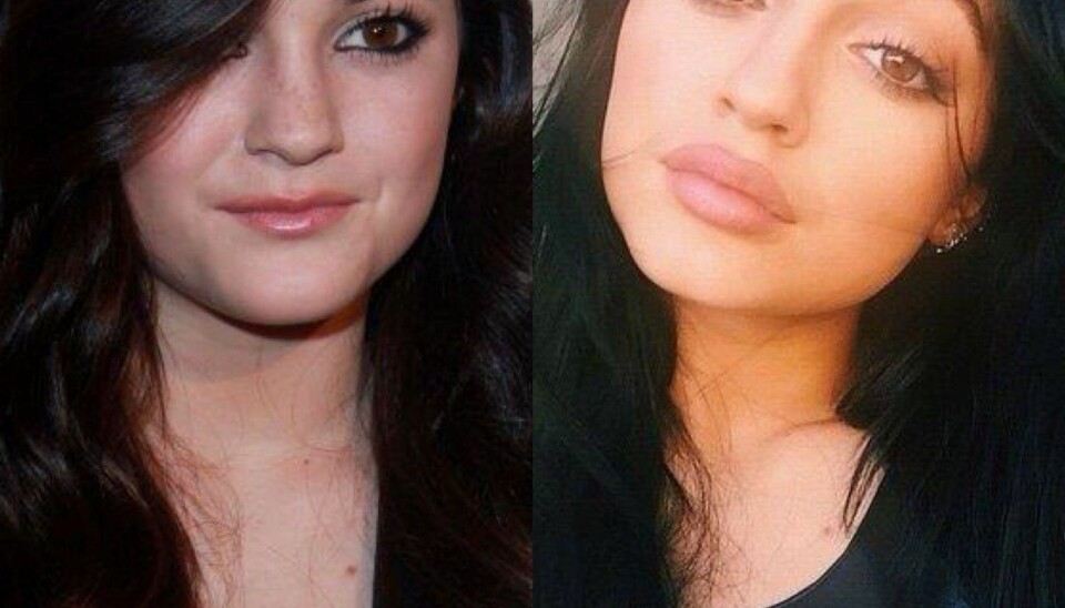 12 kjendiser som er FOR glad i botox!