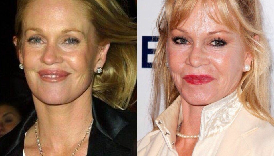 12 kjendiser som er FOR glad i botox!