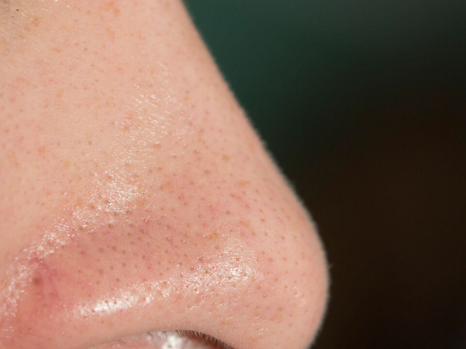 Derfor får du sorte prikker i ansiktet