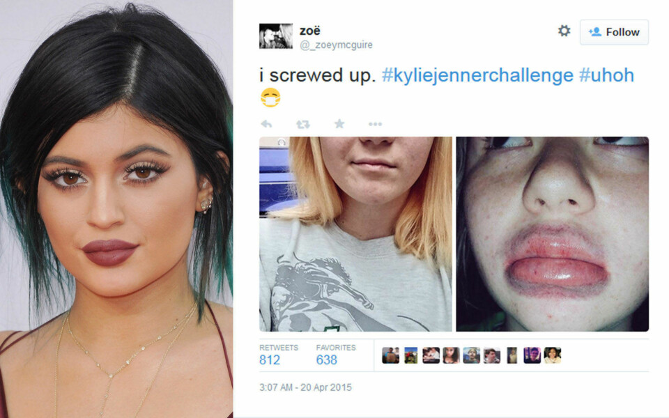 KOPIERER: Kylie Jenners fyldige lepper blir ivrig kopiert av jenter på sosiale medier - og resultatet er i flere tilfeller direkte forstyrrende.