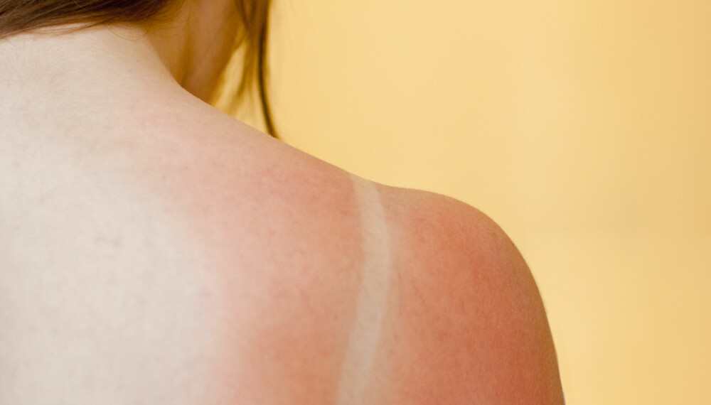 SOLBRENT: Solbrenthet kan være både ubehagelig og smertefullt. Vi gir deg forebyggende råd og tips til behandling.