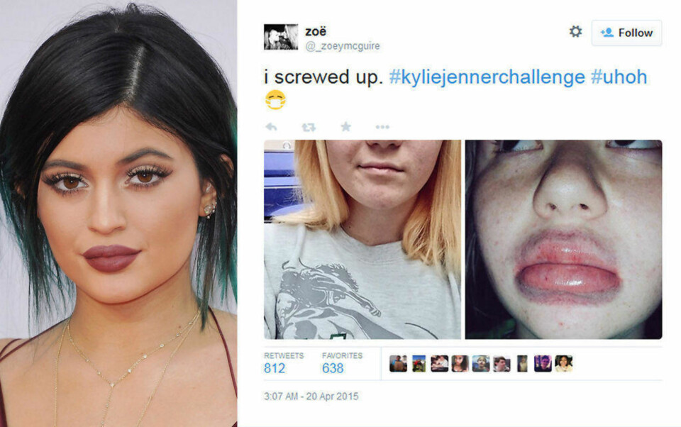 POPULÆRT I 2015: Kylie Jenners fyldige lepper ble ivrig kopiert av jenter på sosiale medier - og resultater ble i flere tilfeller direkte forstyrrende.