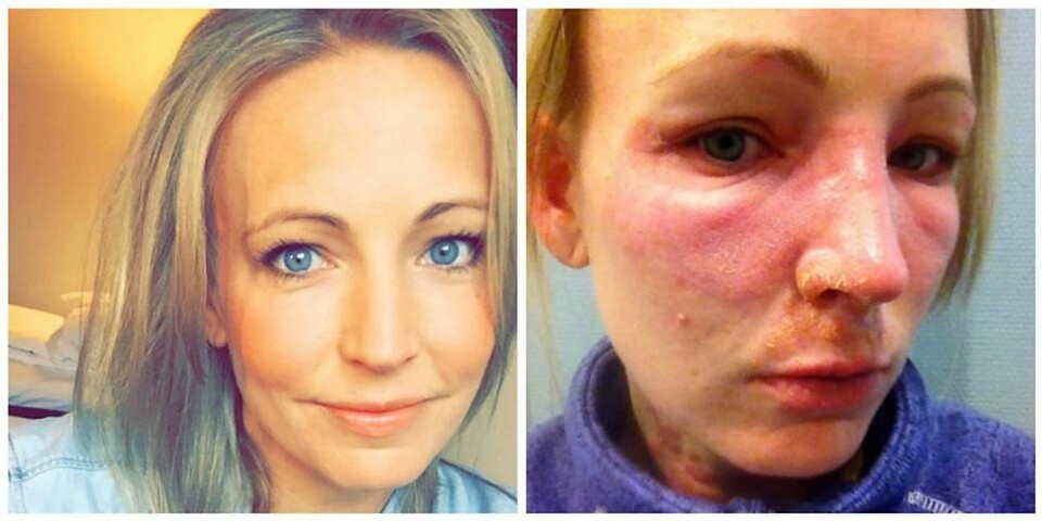 VIL ADVARE: Birgitte Viksund la ut disse bildene av seg selv på Facebook for å advare om ny allergi.