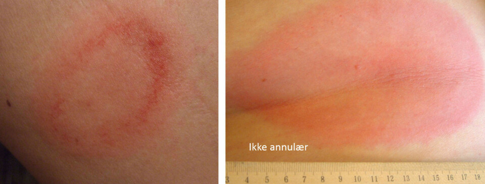 Dette er ikke utslett fra flått