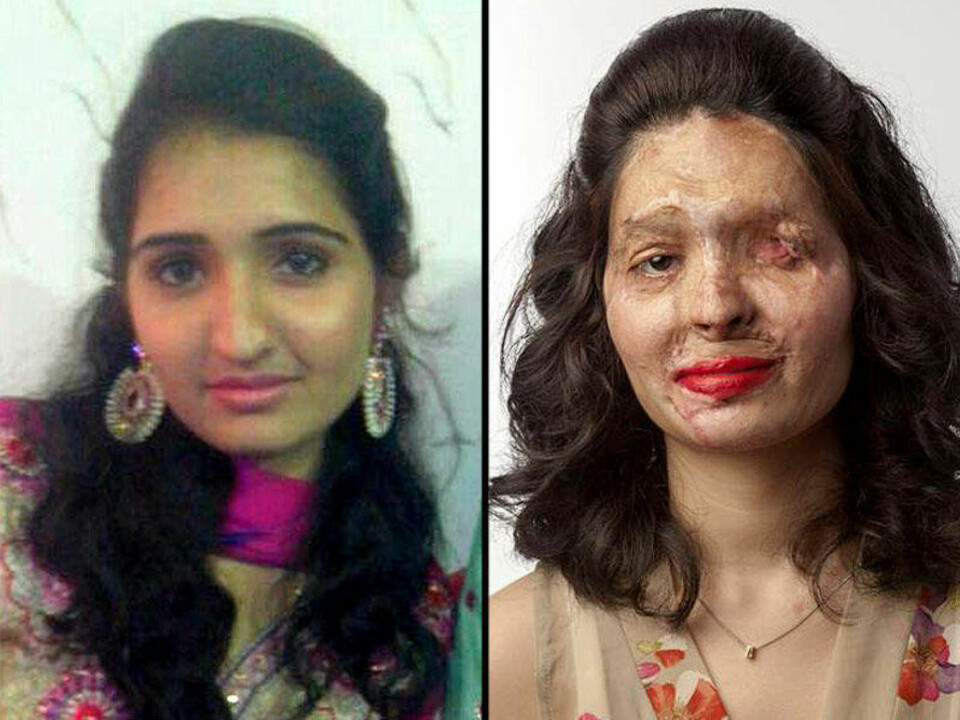 Reshma Quereshi var en vakker 17-åring før hun ble angrepet med syre av svogeren og to andre menn, fordi hun var for pen.