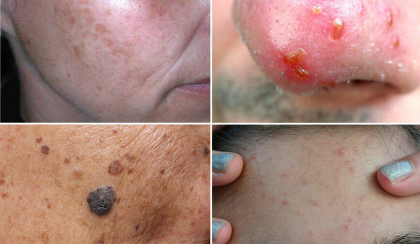 Disse solskadene kan ramme deg om du ikke beskytter deg i påskesolen