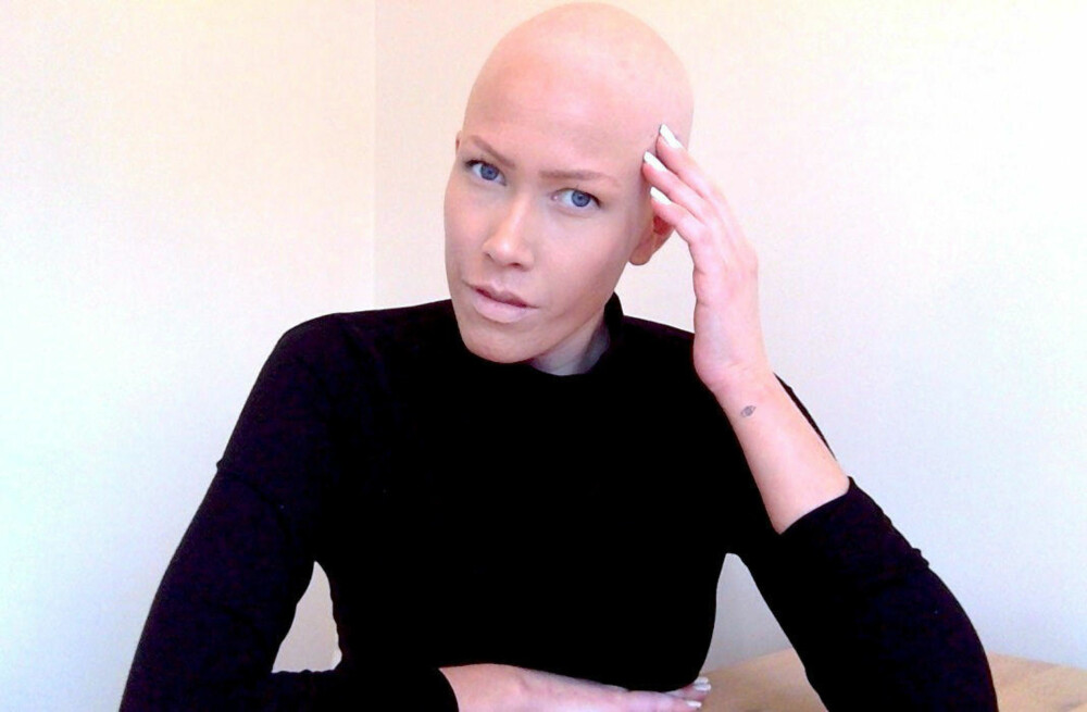 TABU: I april fjernet Thea Steen de siste hårfjonene etter cellegiftbehandlingen, og sier hun føler seg sterkere og vakrere uten hår.