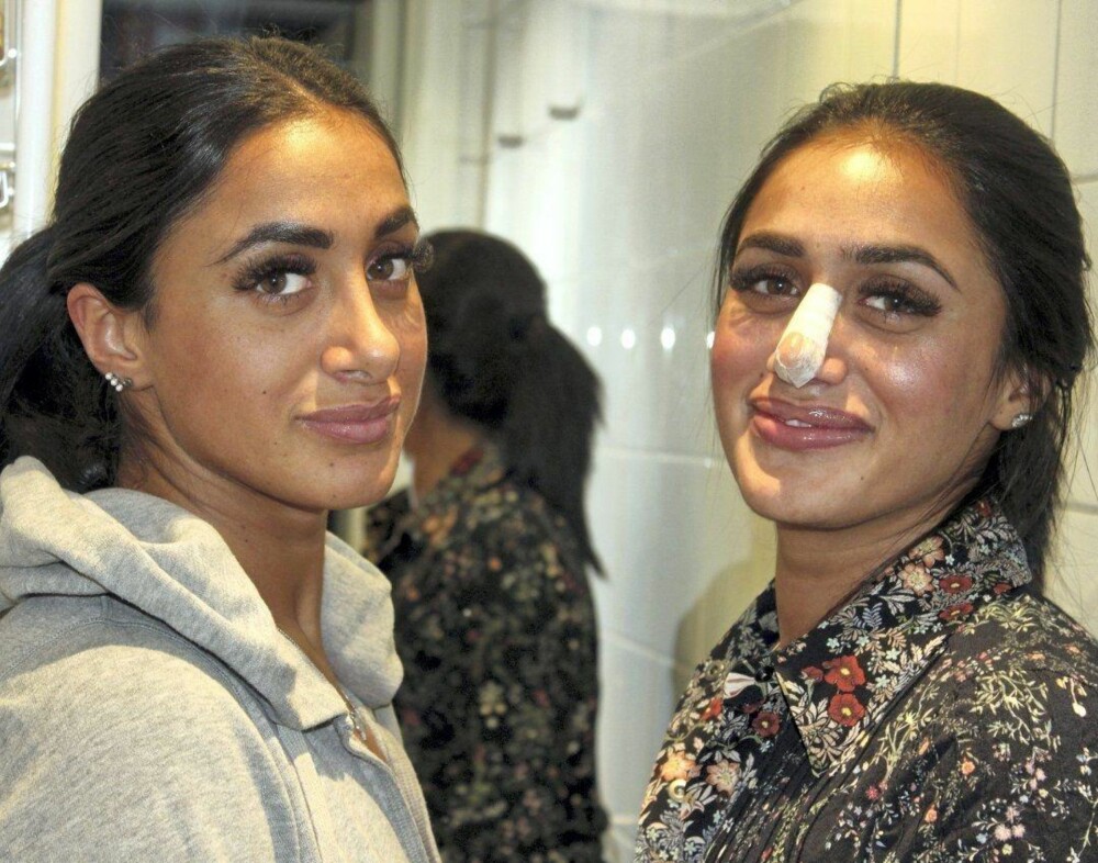 NYOPERERT: Vita Mashadi (t.v.) opererte nesen sin i Iran 31. mars. Om noen dager kan hun ta av det hvite plasteret over neseryggen. Tvillingsøster Wanda opererte nesen sin for to år siden på en privatklinikk i Oslo.