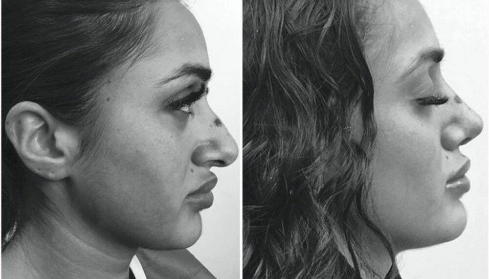 FØR OG ETTER: Vita reiste til Iran for å operere nesen sin. Til venstre slik den så ut før hun reiste, og bildet til høyre er tatt kun få dager etter operasjonen.