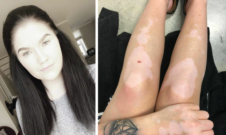 Vilde (18) har pigmentflekker over hele kroppen