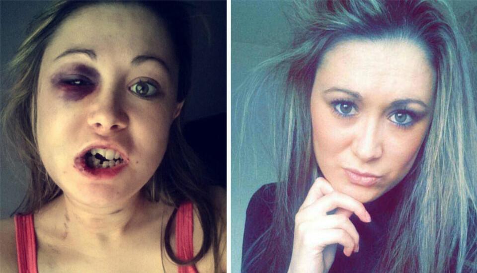 MISHANDLET: I april i år ble Stephanie Littlewood (32) fra Leeds i Storbritannia nesten slått i hjel av hennes daværende kjæreste fordi hun ikke ville ha sex med ham. Nå vil hun advare alle kvinner om ham. Foto: Facebook