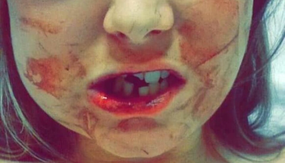 MISHANDLET: I april i år ble Stephanie Littlewood (32) fra Leeds i Storbritannia nesten slått i hjel av hennes daværende kjæreste fordi hun ikke ville ha sex med ham. Nå vil hun advare alle kvinner om ham. Foto: Facebook