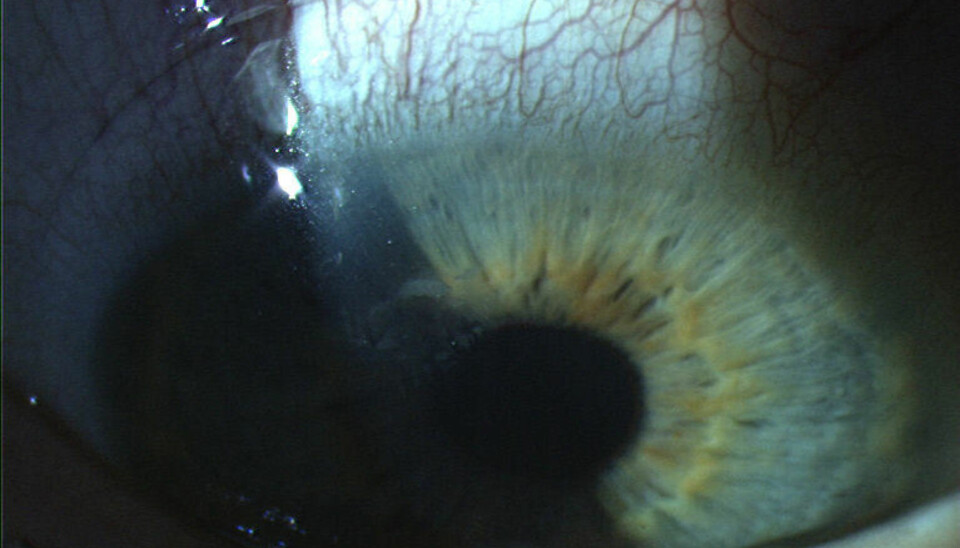 Fargelinser til Halloween kan gi alvorlige øyeskader