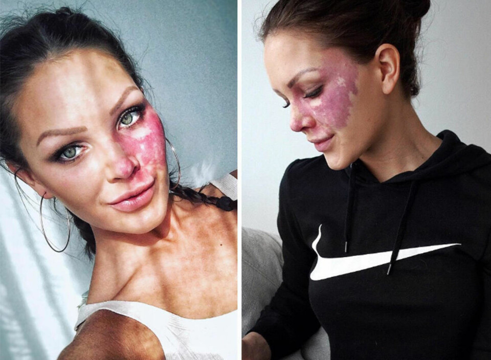 Marina (25) nekter å skjule fødselsmerket sitt og vil vise at å se annerledes ut er vakkert