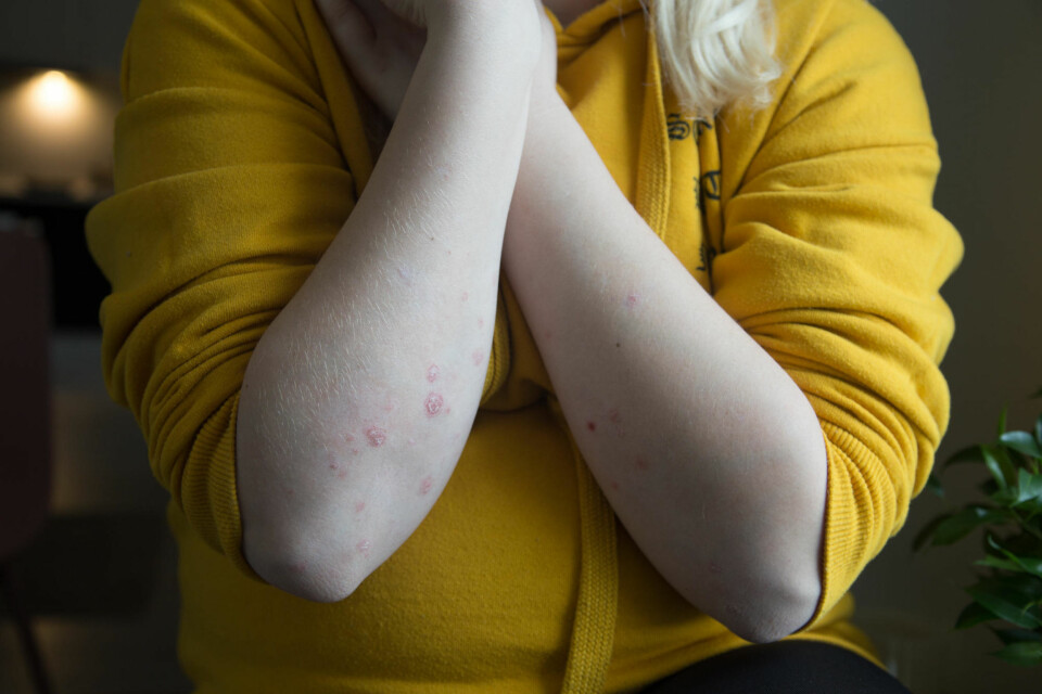 Malin (23) fikk stygge kommentarer for psoriasisen. Så bestemte hun seg for å slutte å skjule den