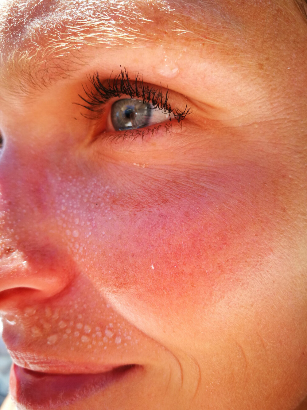 SOLSKADER: Solbrenthet og pigmentflekker trenger behandling. Vi gir deg gode råd med eksperthjelp fra kosmetisk dermatologisk sykepleier Helene Skoje. Illustrasjonsfoto. 