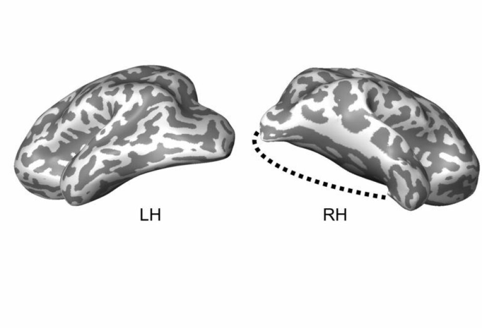 Illustrasjonen viser guttens venstre og høyre hjernedel etter operasjonen. Den prikkete linjen markerer hvor mye av hjernen som er operert bort.