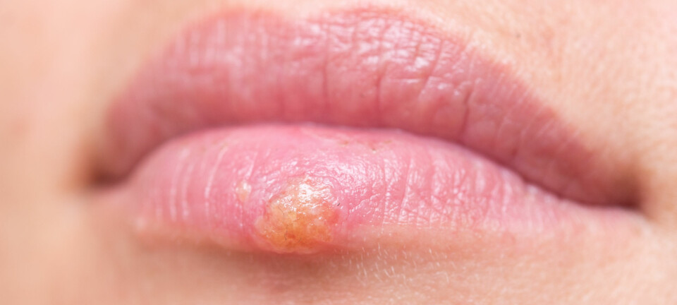 - Det første utbruddet er ofte verst - flere får store, og mange blemmer