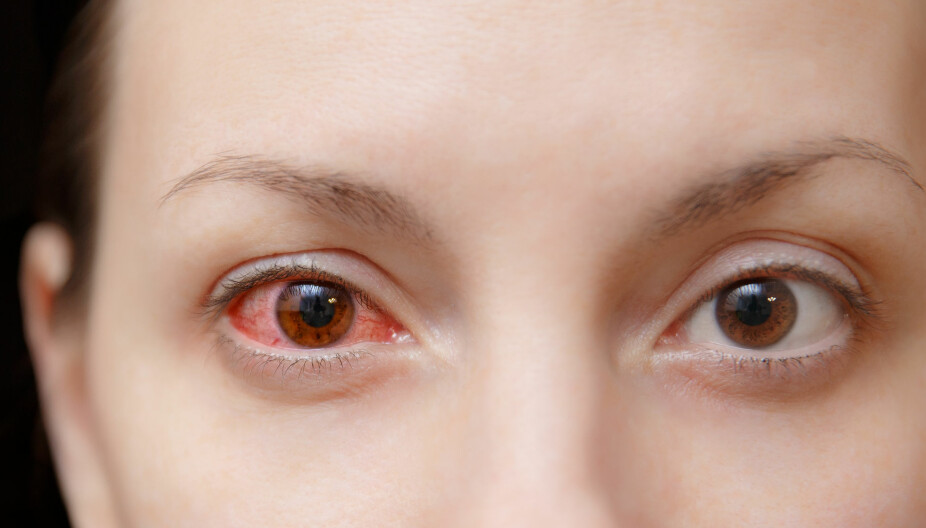 HERPES: Dersom du smittes av herpesvirus i øyet kan det få alvorlige følger.