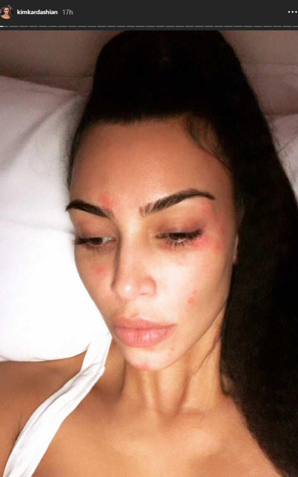 UTEN SMINKE: Kim Kardashian har hudtilstanden psoriasis og viste frem huden sin uten sminke på Instagram stories nylig.
