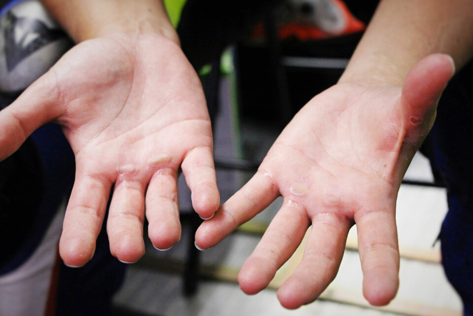 PLAGET AV VARMEN: Høy luftfuktighet og varme gjør at svetten renner ned i hanskene, og gassen glipper. Resultat: Rikelig med vannblemmer.