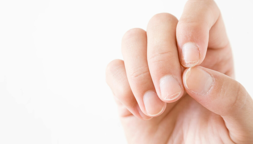 NEGLER AVSLØRER SYKDOM: Sjekk hva neglenes utseende kan fortelle om helsetilstanden din.