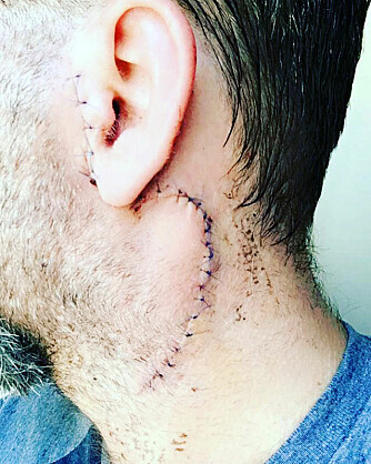 MERKET FOR LIVET: Adam ble rammet av en svulst i hodet i 2017 og bestemte seg for å takle det på egenhånd. Det var en feilvurdering.