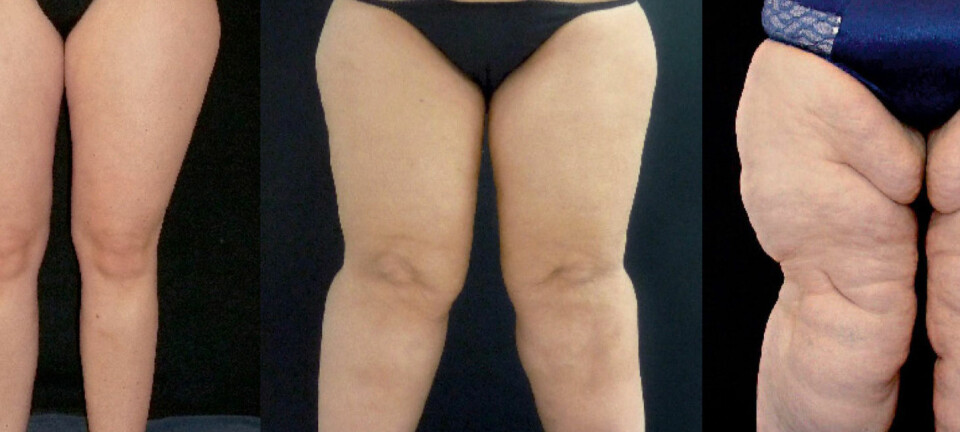 Diagnosene som kan være årsaken til at du aldri lykkes med slankingen