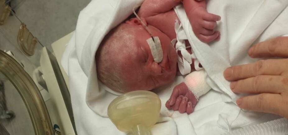LITEN TØFFING: Normalt fødes barn med gastroschise ved keisersnitt i uke 36, men svangerskapsforgiftning i uke 32 gjorde at babyen måtte ut i all hast. LITEN TØFFING: Normalt fødes barn med gastroschise ved keisersnitt i uke 36, men svangerskapsforgiftning i uke 32 gjorde at babyen måtte ut i all hast.