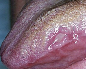TUNGEPLAGE: Bildet viser et eksempel på misfarging og munnskold/afte på tungeranden.