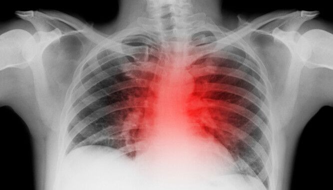 VOLDSOMT: Hjerteflimmer kan føles ut som at ma har en traktor i brystkassa.