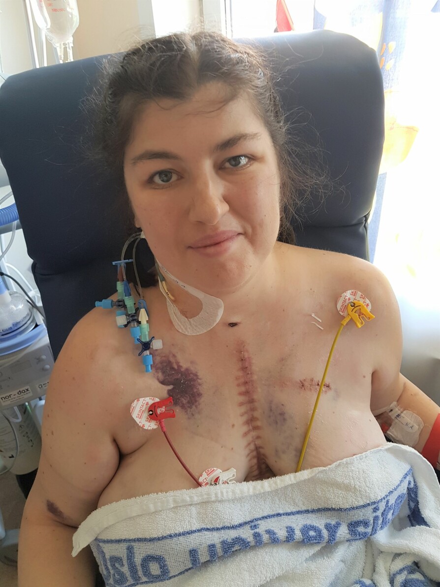 MERKET FOR LIVET: Katie har flere operasjonsarr enn de aller fleste, Slik så hun ut etter hjertetransplantasjonen.