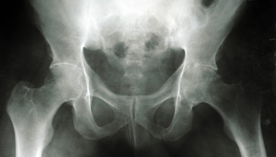 BENSKJØRHET: Et røntgenbilde viser forandringer i skjelettet i et tilfelle av osteoartrose på venstre hofte.