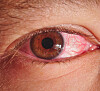 Øynene kan vise symptomer på sykdom - Sykdommer